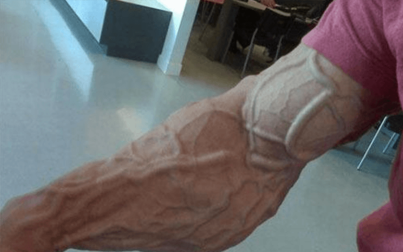 What Do Large Veins Mean