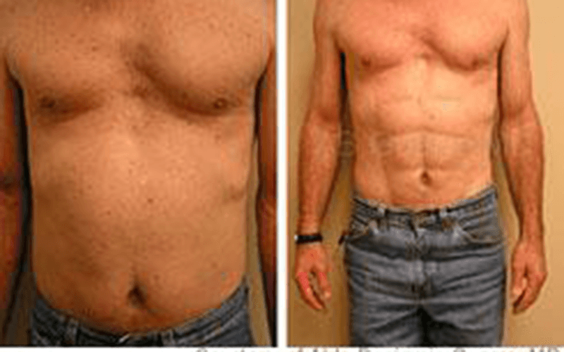 Ever Seen a Surgically Created SixPack?