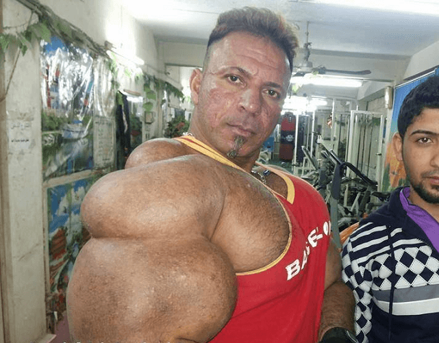 The Grossest Synthol Freaks On The Internet