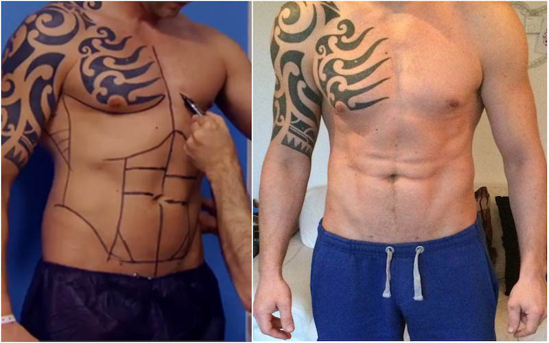 Would You Travel Across Europe To Get Ab Implants? This Guy Did