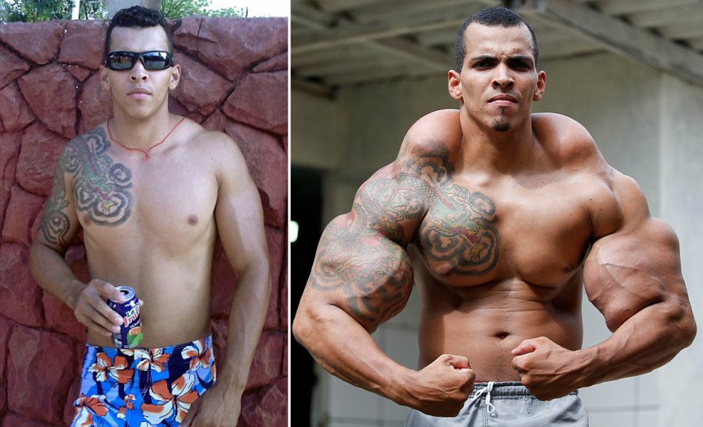 synthol-user-has-to-have-his-arm-amputated