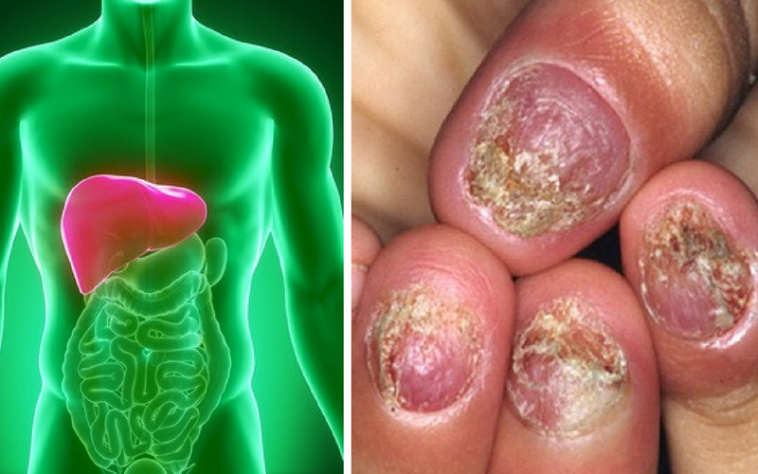 8 Ways Your Body Tells You That Your Liver Is Damaged