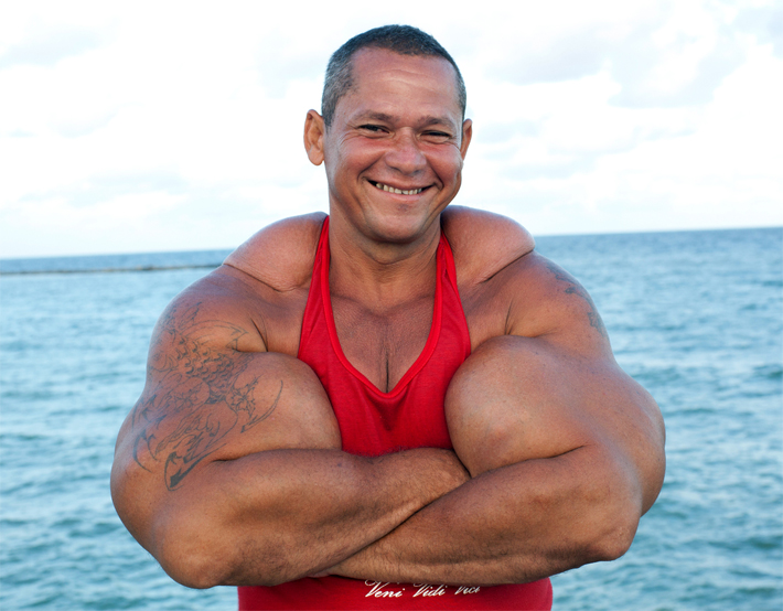 Bodybuilder Blows Arms Out With Oil Injections   Synthol Freak 