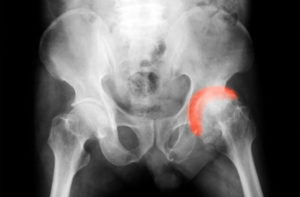 xray showing reduced range of motion in the hip which could be tackled using third world squats