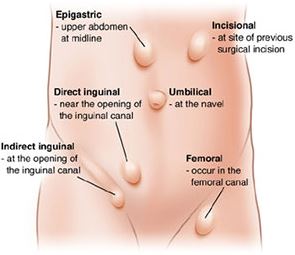 Different types of hernia