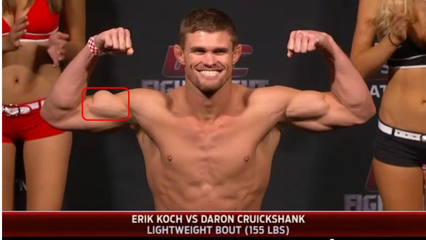 Erik Koch bicep tear