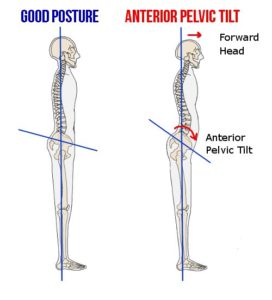 Anterior pelvic tilt