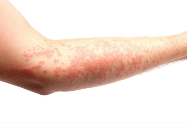 can niacin cause a rash