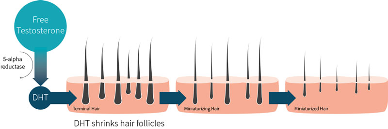 Illustration showing hair follicle miniaturisation process